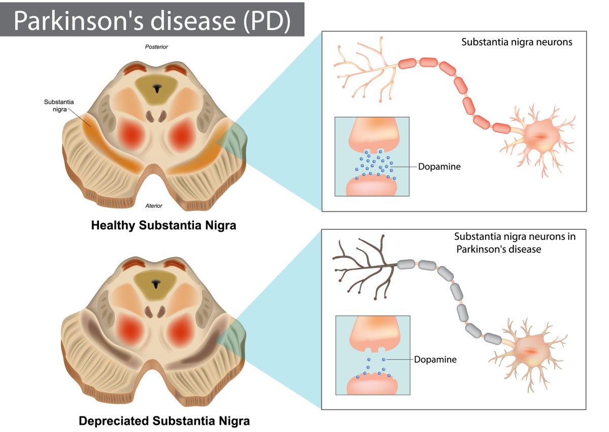 Parkinsonova choroba a nedostatečný přenos dopaminu v mozku. Zdroj foto: Getty Images Parkinsonova choroba a nedostatečný přenos dopaminu v mozku