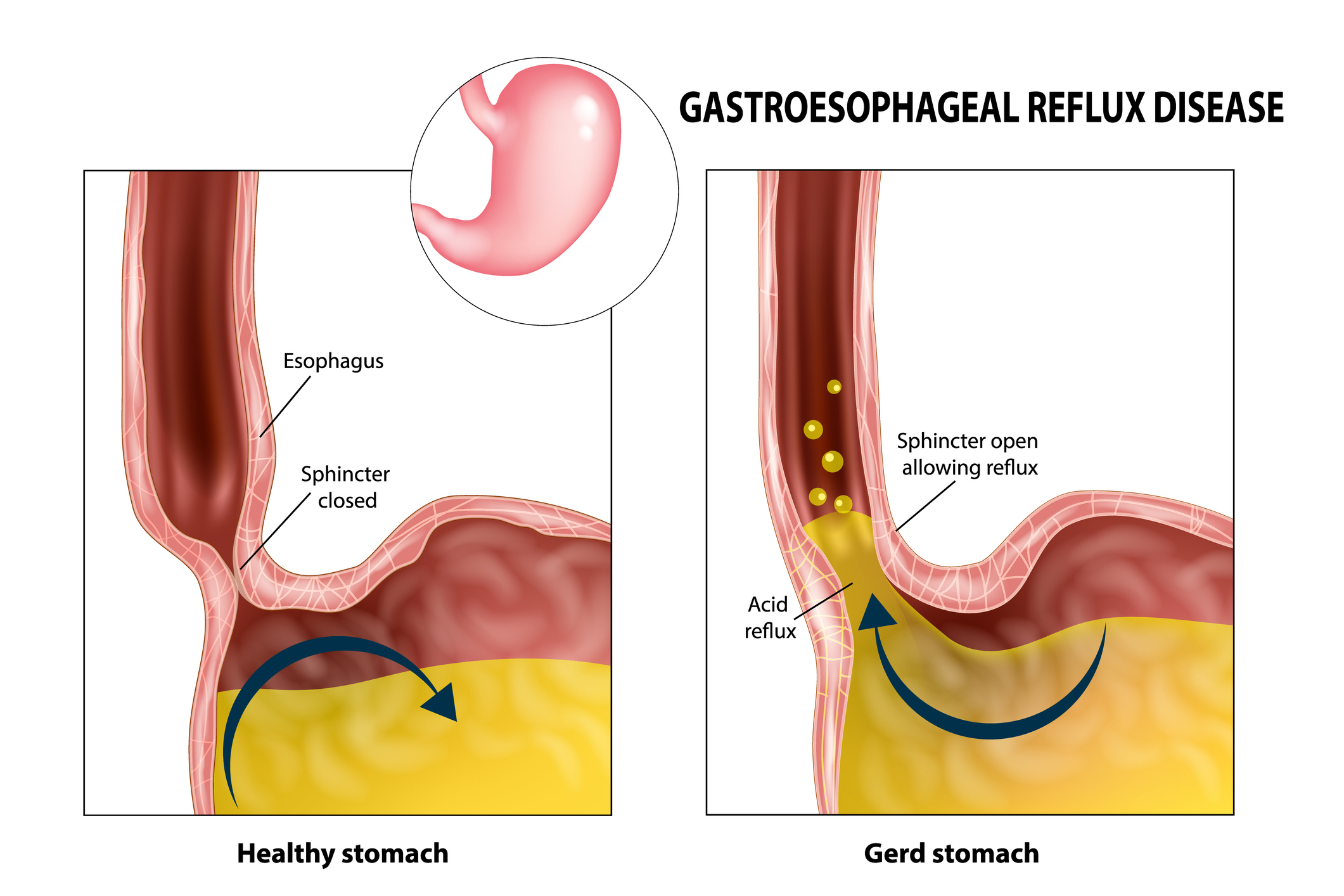 Reflux (pálení žáhy) jako možný zdroj zápachu z úst. Zdroj fotografií: Getty Images Reflux (pálení žáhy)