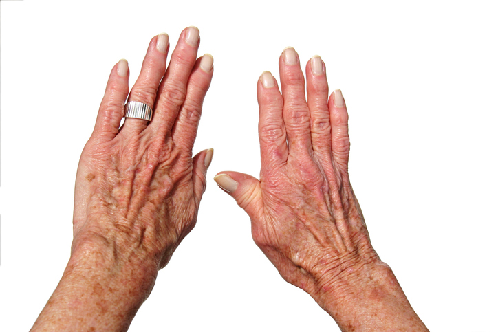 dvě ruce, artritida, revma, bolestivé a oteklé klouby prsty na rukou