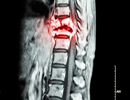 RTG snímek hrudní páteře s důkazem rakoviny v oblasti hrudní páteře