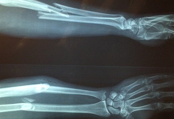 RTG snímek předloktí s důkazem fraktury předloktím, komplikovaná zlomenina s dislokací