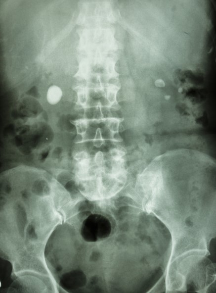 RTG snímek břicha, ledvinové kameny na obou stranách, v obou ledvinách