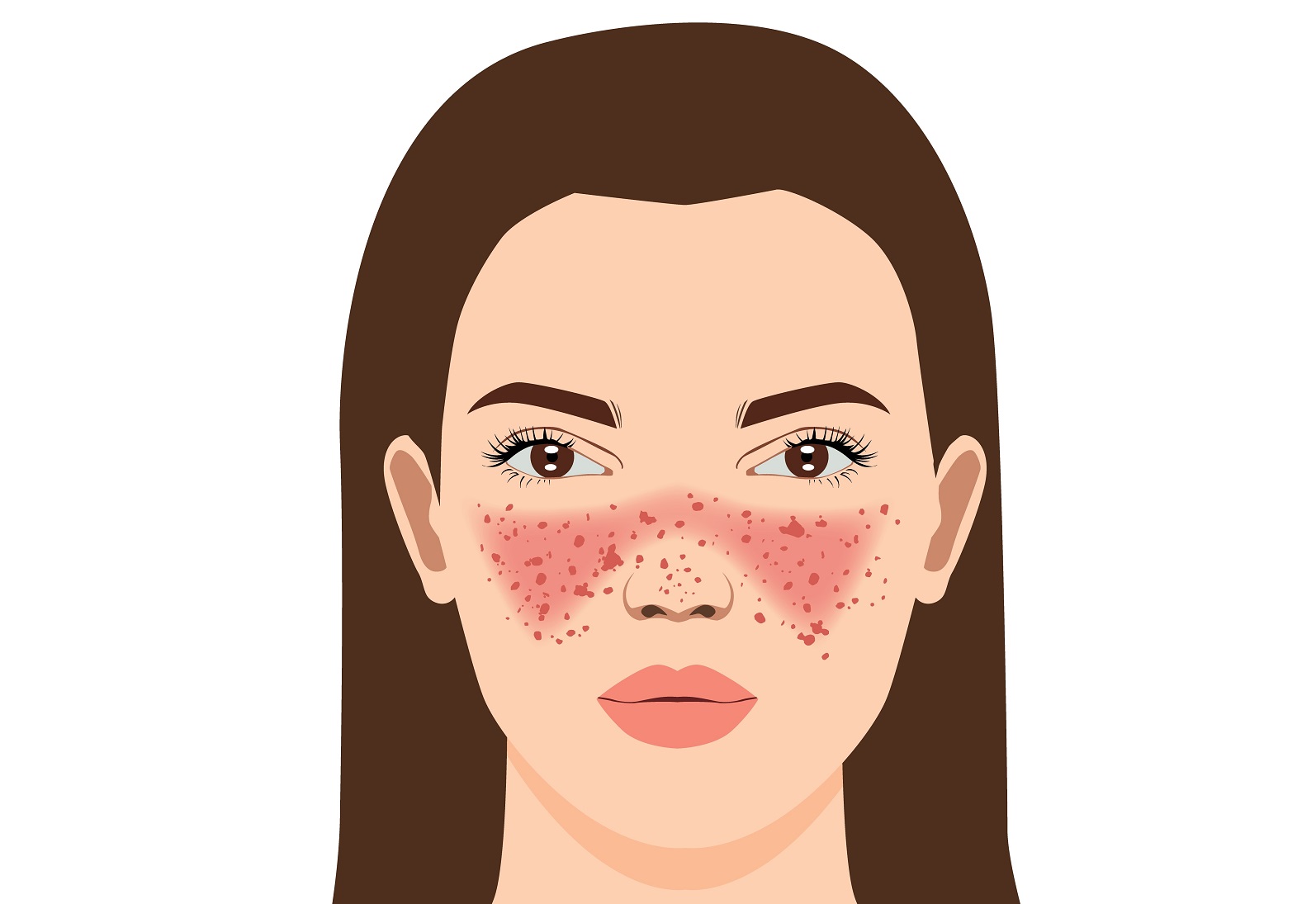 Motýlí zarudnutí kůže - motýlovitý erytém. Zdroj fotografií: Shutterstock anatomický - animované zobrazení erytému ve tvaru motýla na ženské tváři.