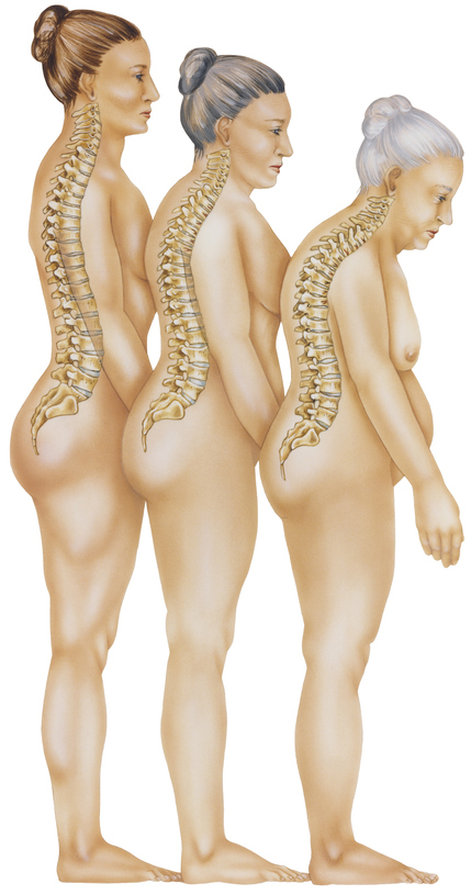 stojící postavy tří žen, znázorňují degenerativní změny postoje následkem osteoporózy