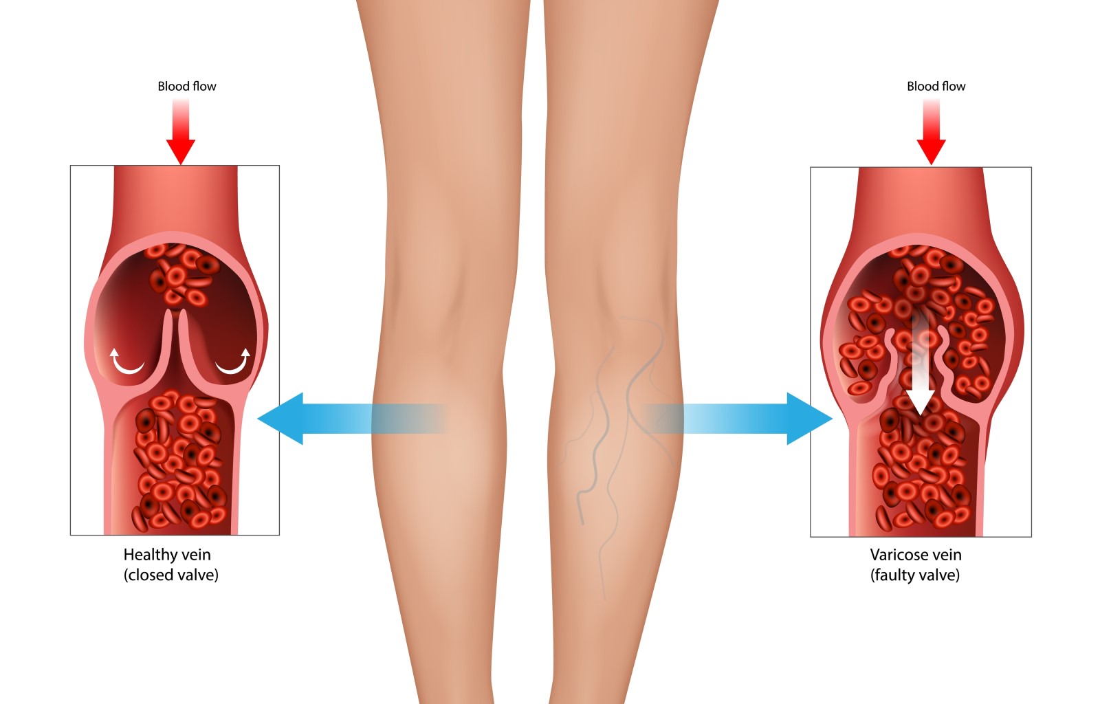Zdravá žíla dolní končetiny - uzavřená chlopeň (vlevo) a křečová žíla - poškozená chlopeň (vpravo). Zdroj fotografie: Shutterstock Anatomické a animované zobrazení normální žíly dolní končetiny (vlevo) a křečové žíly (vpravo).