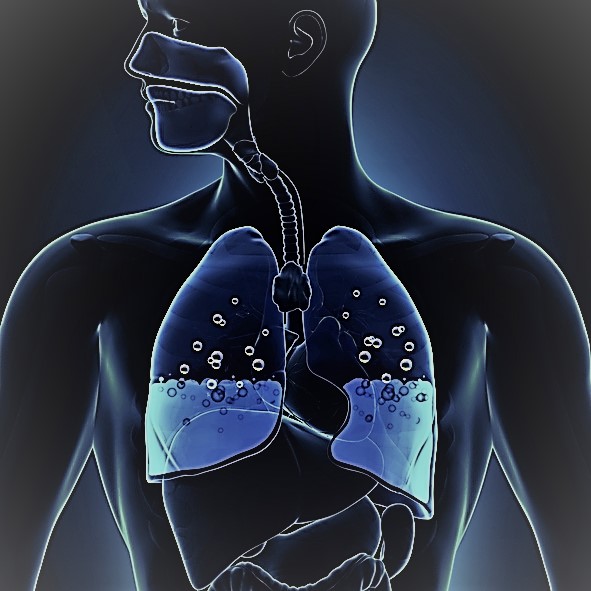 Schématické znázornění plic s otokem, voda do poloviny plic, dýchací cesty