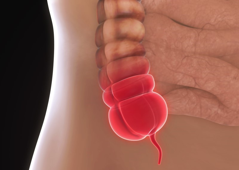 Model zaníceného apendixu - anatomické zobrazení