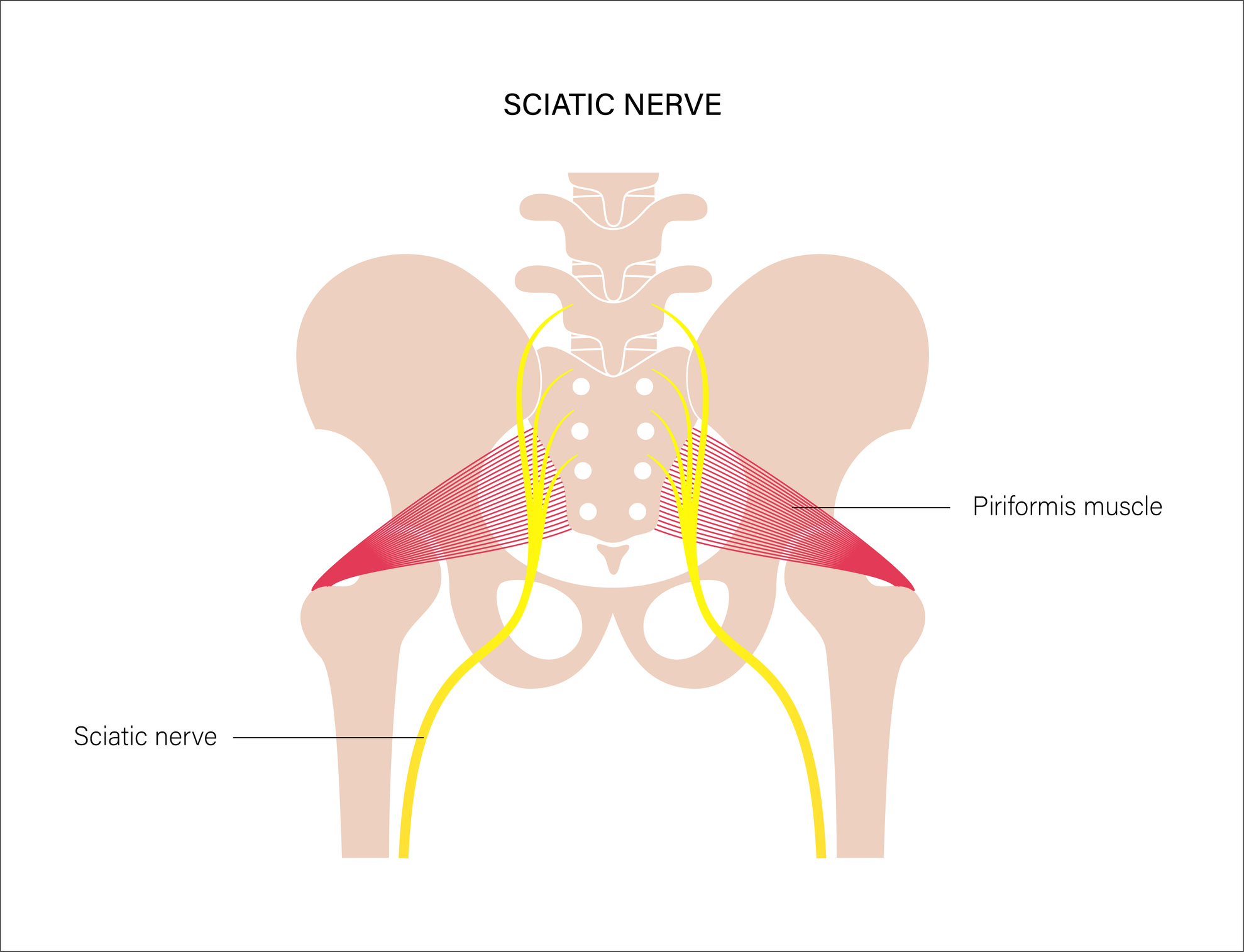 Zánět sedacího nervu (ischias) a sval musculus piriformis s tendencí ke stažení a kompresi