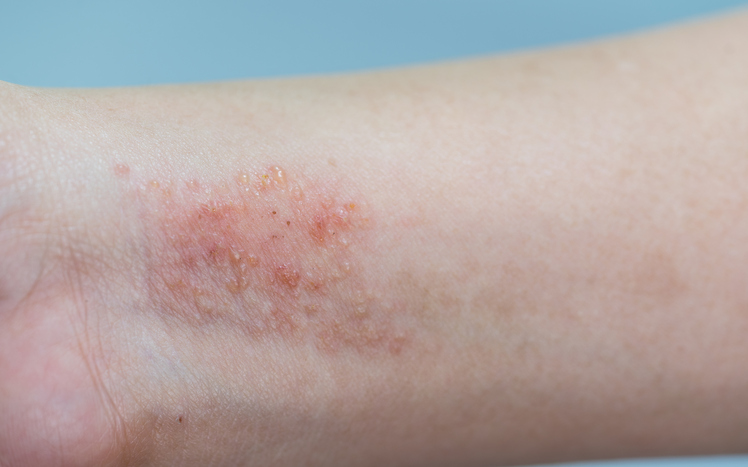 Ekzém na zápěstí a předloktí, mokvající, zarudlý zánět kůže, například kontaktní dermatitida