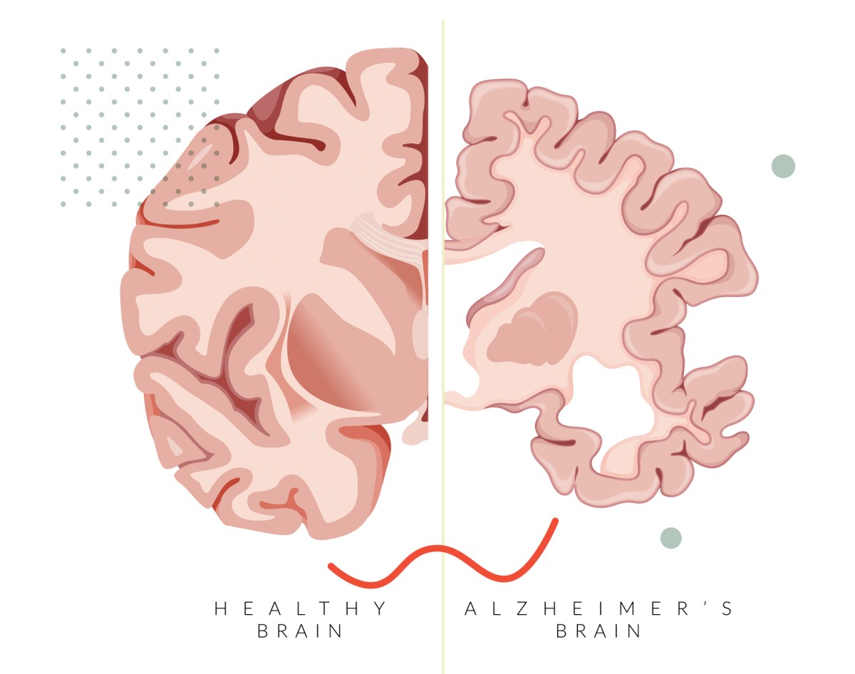 Srovnání: zdravý mozek a mozek postižený Alzheimerovou chorobou se ztrátou buněk. Zdrojové foto: Getty Images Srovnání: zdravý mozek a mozek postižený Alzheimerovou chorobou se ztrátou buněk