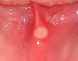 malá afta na sliznici dutiny ústní