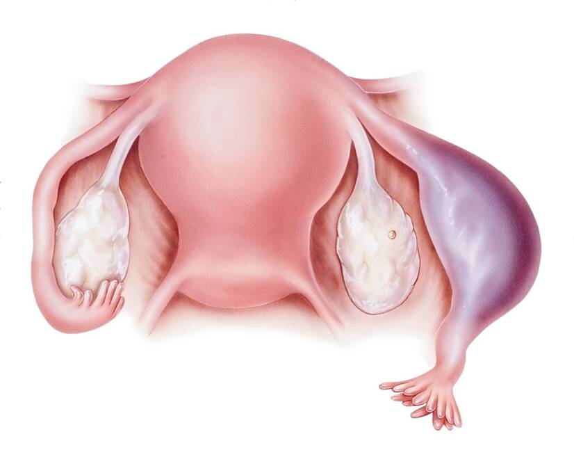 Vývoj a růst oplodněného vajíčka ve vejcovodu, hrozí jeho prasknutí a následné krvácení. Zdroj: Getty Images