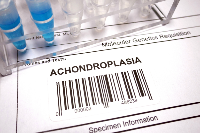 Achondroplázie: Jaké jsou příčiny, příznaky vrozené poruchy kostí?