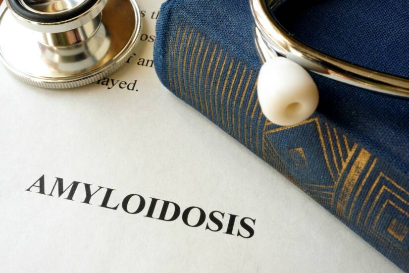 Amyloidóza: Co to je a proč vzniká, jaké má příznaky?