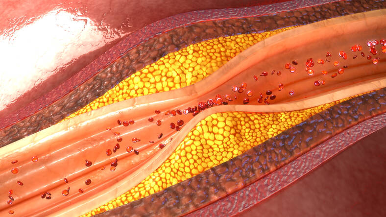 Ateroskleróza: Znáte příznaky či příčiny vzniku, rizika, prevenci?