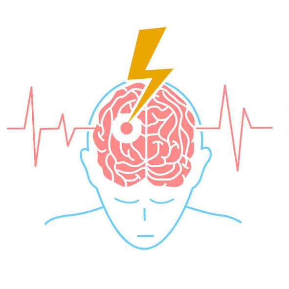 Co je to cévní mozková příhoda? Znáte příznaky, rizika a léčbu? 