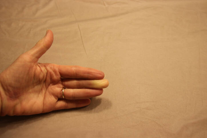 Raynaudův syndrom: Jaká je příčina nedokrvení prstů na rukou?
