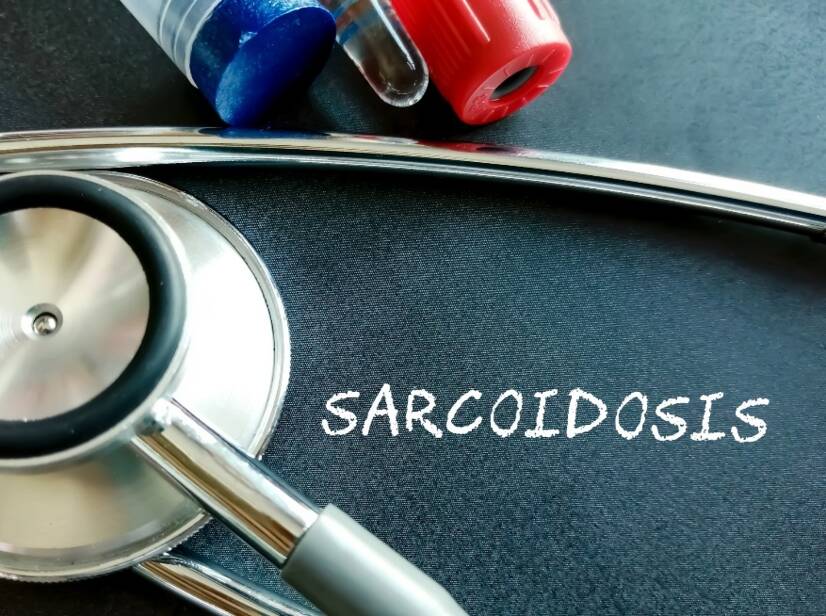 Sarkoidóza: Co je to sarkoidóza a jaké jsou její příčiny/příznaky? Plicní i mimoplicní formy
