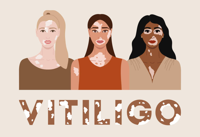 Vitiligo: Co je to vitiligo a jaké jsou jeho příčiny a příznaky? Kdy začíná?