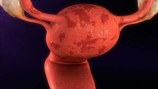 Jak spolu souvisí endometrióza a neplodnost? + Ostatní příznaky a zdravotní potíže