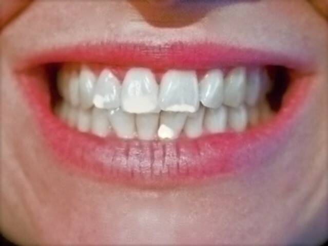 Bílé skvrny na zubech a jejich příčiny? Jak si pomoci a fleky odstranit?