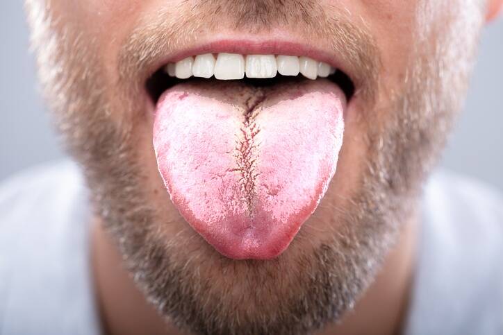 Bílý povlak na jazyku: Jaké má příčiny a jak ho odstranit?