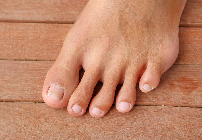 Deformované nehty – jaké jsou jejich nejčastější příčiny?