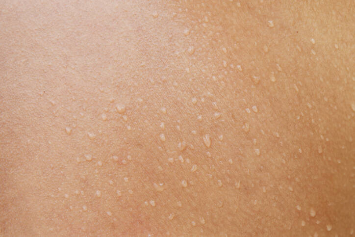 Mokvání kůže kvůli zánětu, dermatitidě nebo ekzému? Poznejte příčiny