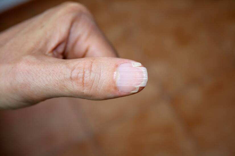 Lámavé nehty a jejich hlavní příčiny? Jak se s nimi dá bojovat?
