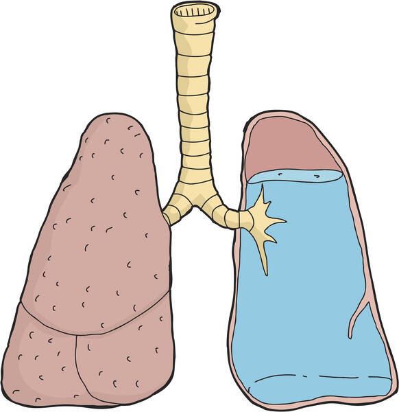 Otok plic: Proč vzniká edém plic? Je častou příčinou smrti?