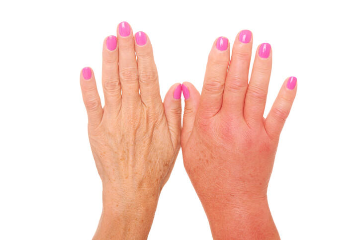 Oteklé prsty: Proč nám prsty otékají, jaké onemocnění to značí?