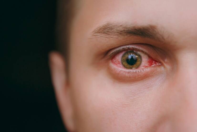 Zarudnutí očních spojivek: Jaké má příčiny? (+ příznaky)
