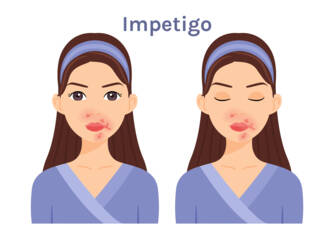 Co je impetigo, jaké má příznaky? Infekčnost a přenos u dětí
