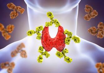 Autoimunitní zánět štítné žlázy: Hashimotova nemoc. Příčiny, příznaky