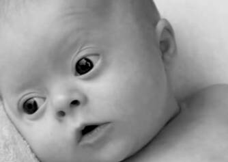 Downův syndrom: co to je, co ho způsobuje? Diagnostika a porozumění