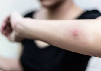 Kožní absces: Co je, jaké má příčiny a příznaky infekce kůže?