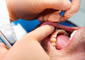Paradentóza: Proč vzniká? + Jak zastavit kývání zubů a zpevnit je?