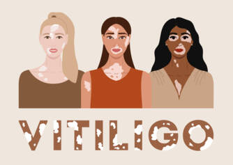 Vitiligo: Co je to vitiligo a jaké jsou jeho příčiny a příznaky? Kdy začíná?