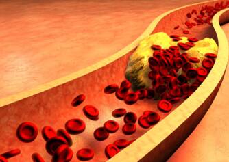 Zvýšená hladina cholesterolu: co je LDL (špatný) a HDL (dobrý) cholesterol? Jaké jsou příčiny?