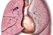 Plicní embolie: Proč vzniká, jak se projevuje, zjišťuje a léčí?