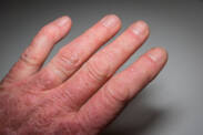 Psoriatická artritida: Příčiny a projevy lupénky se zánětem kloubů?