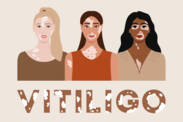 Vitiligo: Co je to vitiligo a jaké jsou jeho příčiny a příznaky? Kdy začíná?
