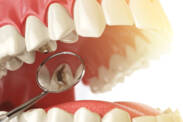 Zubní kaz: Proč vzniká a jak se projevuje? (+ Jak vypadá a léčí se)