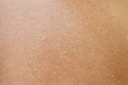 Mokvání kůže kvůli zánětu, dermatitidě nebo ekzému? Poznejte příčiny