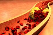 Zvýšená hladina cholesterolu: co je LDL (špatný) a HDL (dobrý) cholesterol? Jaké jsou příčiny?