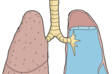 Otok plic: Proč vzniká edém plic? Je častou příčinou smrti?